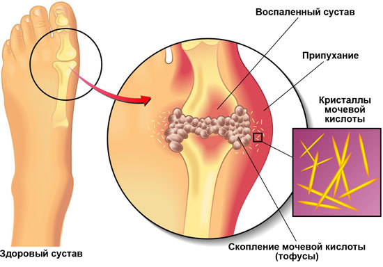 Лечение подагры народными средствами, как лечить подагрический артрит на пальцах ног